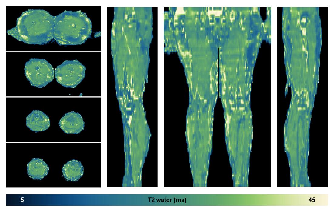 The water only T2 relaxation time of the lower extremity obtained from multi echo spin echo t2 mapping with EPG based reconstruction.